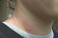 Sting on the neck of this woman by the European fire ant.