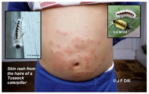 Skin rash on a child from the hairs of a Tussock Caterpillar. Photos by J. Dill, G. Dill, and C. Armstrong.