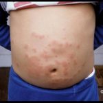 Skin rash on a young boy's chest and abdominal area resulting from the hairs of a Hickory Tussock caterpillar (from a species other than Browntail Moth) (circa early 2000s in Maine)