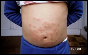 Photo of a skin rash on a child's abdomen resulting from the hairs of a tussock caterpillar