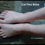 Bites from Cat Fleas on a child's feet and legs