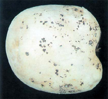Rhizoctonia solani sclerotia on potato tubers.