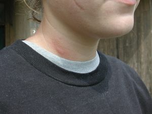 ant sting on the neck