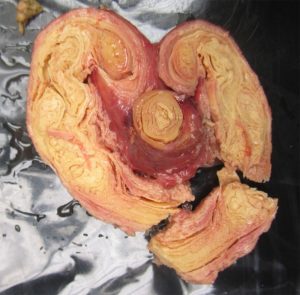 Oviduct from hen with CS. The oviduct is thickened and stiff, and is distended with yellow, layered yolk-like material.