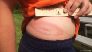 (bulls-eye) rash about 4 inches wide on person's side