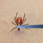 grasping embedded tick behind the head with tweezers