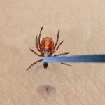Pulling a tick out with tweezers