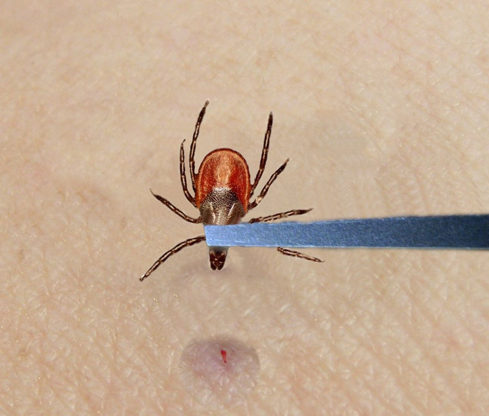 Tick Removal From Humans